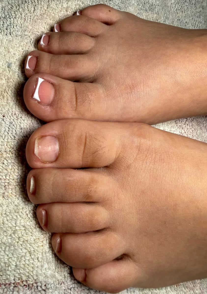 Acripie Uñas Sanas