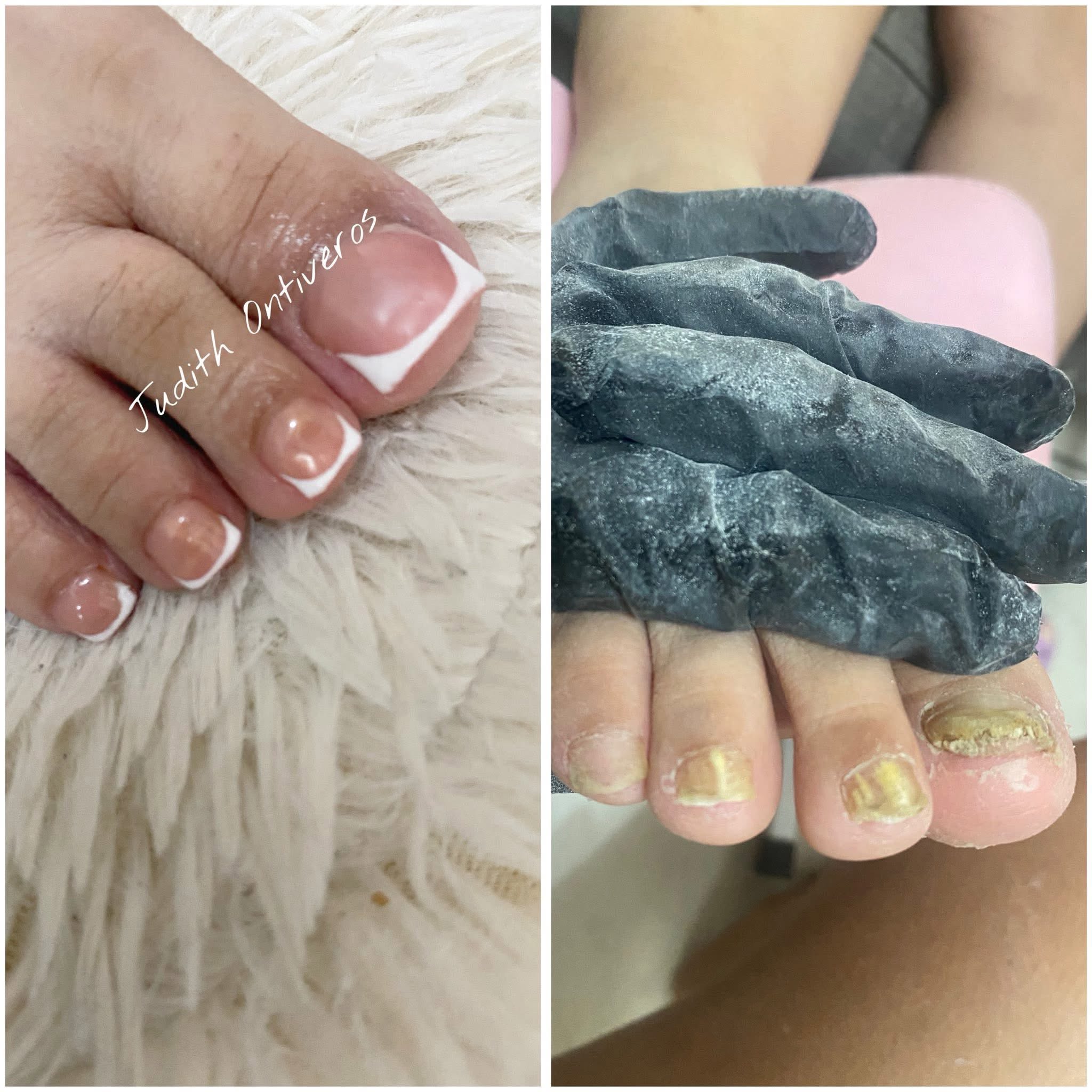 Acripie Uñas Sanas