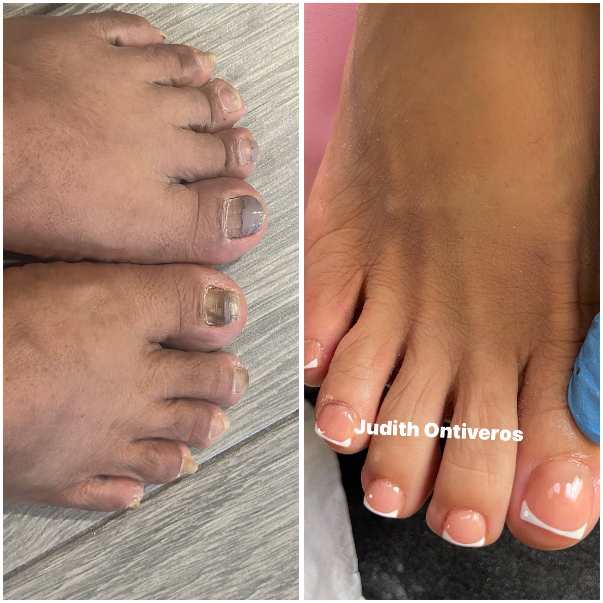 Acripie Uñas Sanas