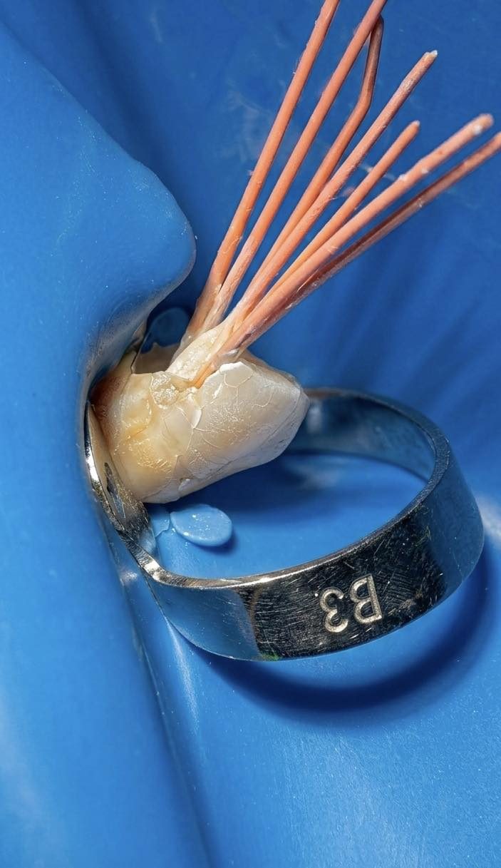 Endodoncias Atención Dental — San José Tecoh