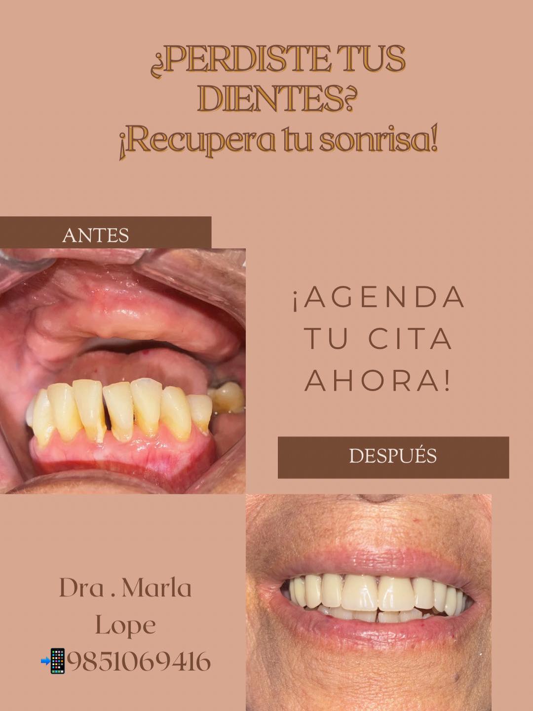 Promoción en Prótesis Dentales y Recuperación de Sonrisa con Dra. Marla Lope
