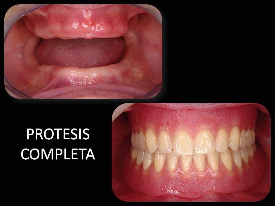 Protesis dentales — San José Tecoh